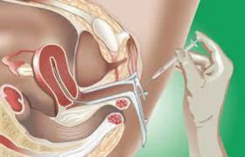 Che cos'è la stimolazione ovarica e quanto dura? | Portale femminile